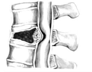 Compressão da medula espinhal