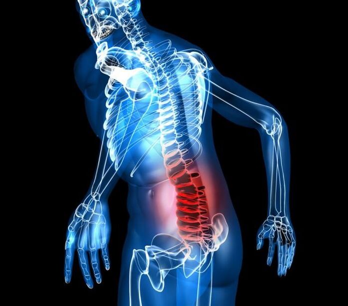 estágios de grau e desenvolvimento da osteocondrose lombar