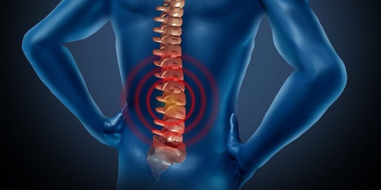 Osteocondrose da região lombar