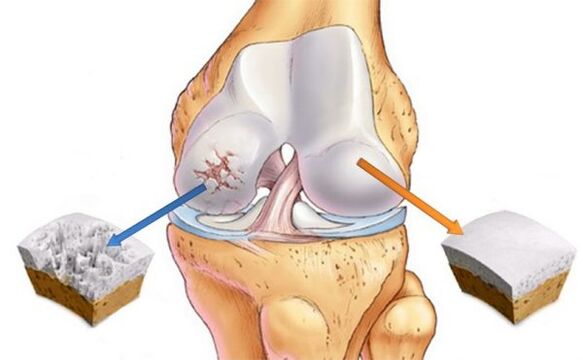 Osteoartrite da articulação do joelho (esquerda) e cartilagem normal (direita)