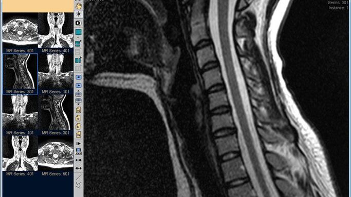 A ressonância magnética da coluna cervical é o melhor método para diagnosticar dor no pescoço