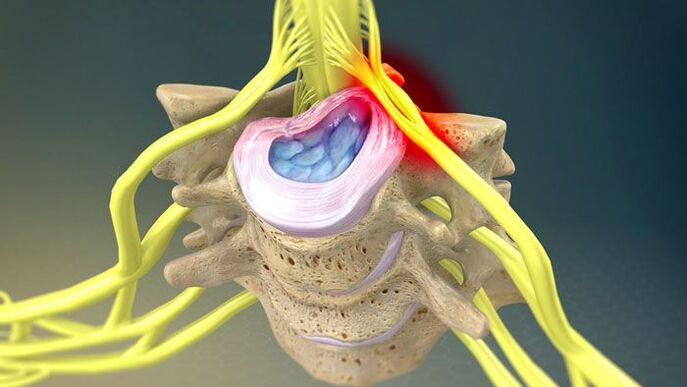 Protusão do disco intervertebral causa dor no pescoço